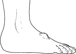 Ganglion Cysts