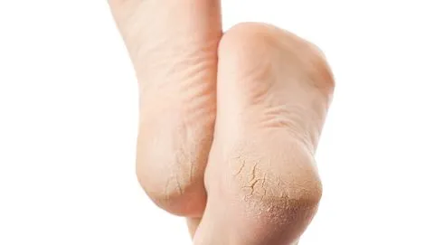 What are heel fissures.